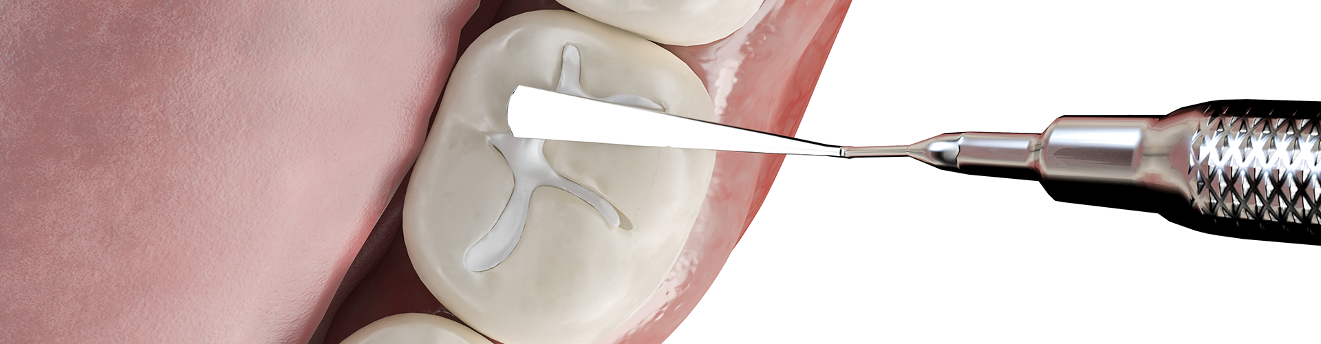 dental tool pressing white material into hole in tooth